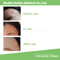 Anti-Acne e Pimple &amp; Skin Care Face Cream